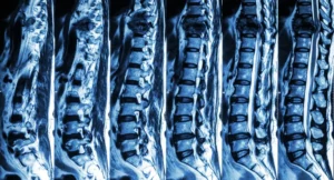 Finding a Specialized Attorney for Spinal Cord Injuries